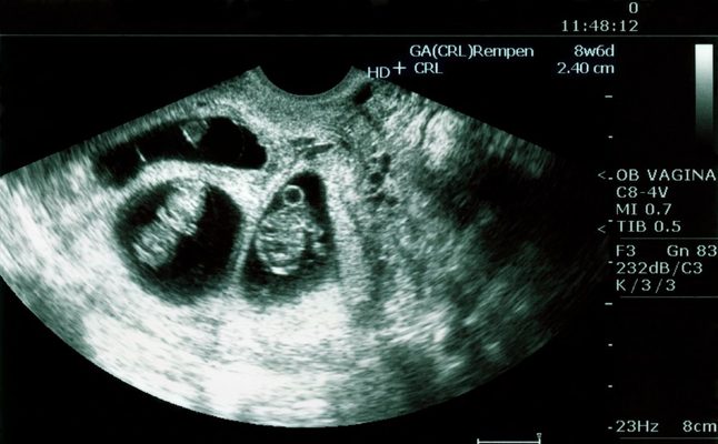 سونار الحمل بتوأم في الشهر الاول mariubuyana