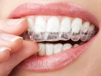 كيف تختارين الوان تقويم الاسنان المناسبة لابتسامتك 3a2ilati