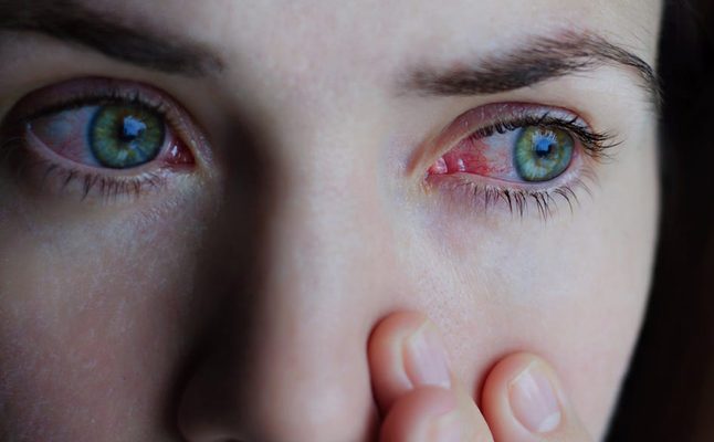 ما سبب احمرار العين بعد النوم وطريقة علاجه | 3a2ilati