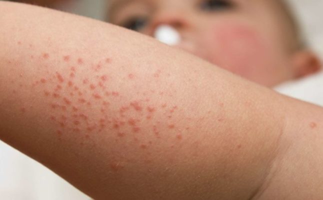 أشهر 4 انواع حساسية تظهر على جلد الطفل وكيفية التعامل معها! Fca2971de83e61846bc1a1970b19212ca3fc4211