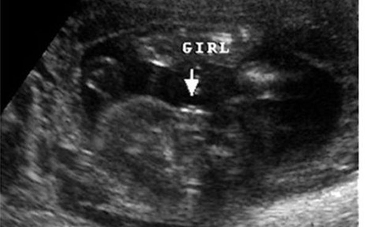 هل يخطئ السونار في تحديد نوع الجنين في الشهر الرابع 3a2ilati
