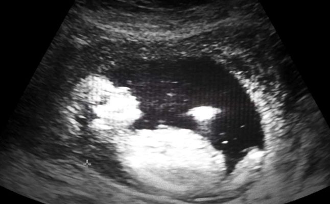 مراحل نمو الجنين بالصور شهريا 3a2ilati